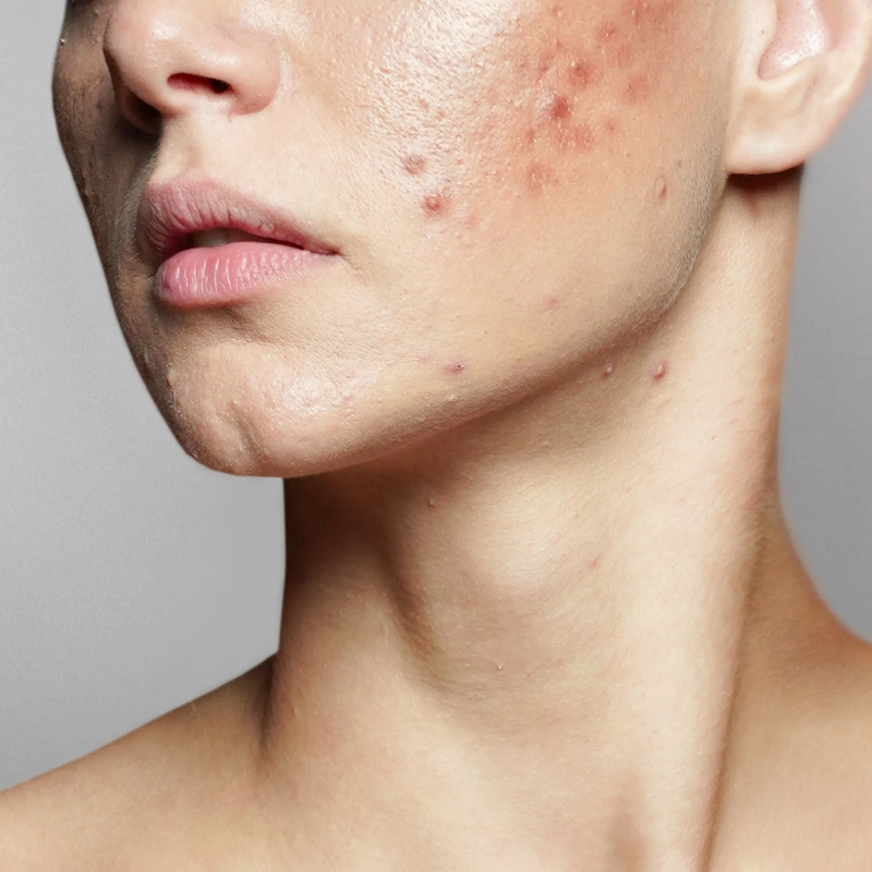 Thắc mắc - Da mụn có nên dưỡng trắng không?