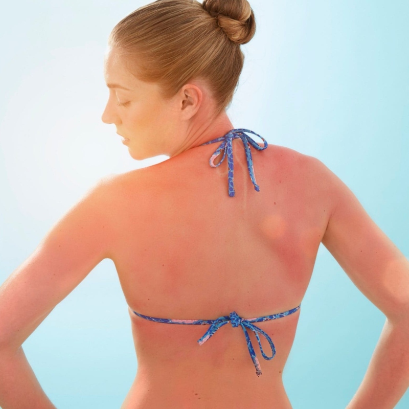 Có ba mức độ da cháy nắng.